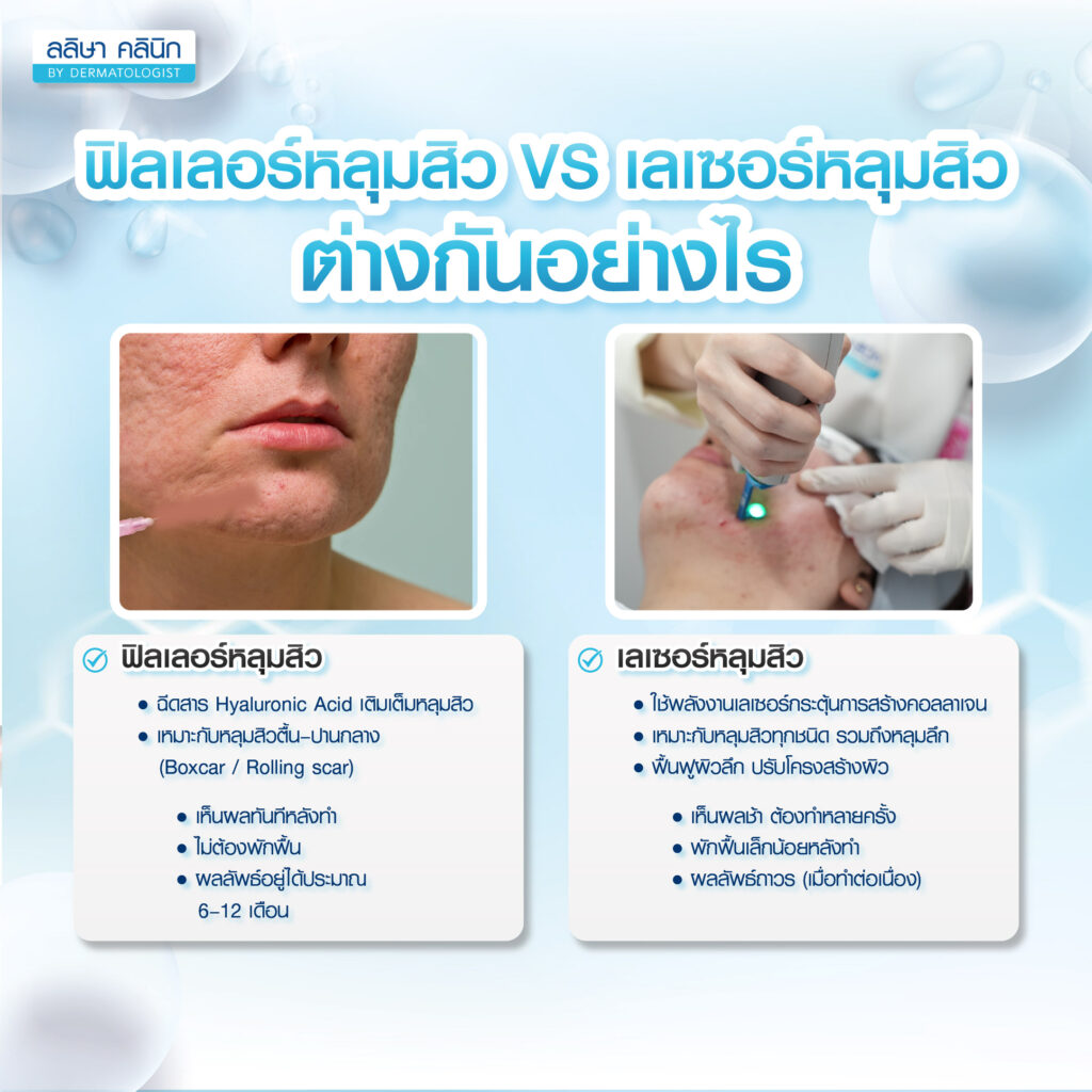 ภาพเปรียบเทียบทำฟิลเลอร์หลุมสิวกับทำเลเซอร์หลุมสิว