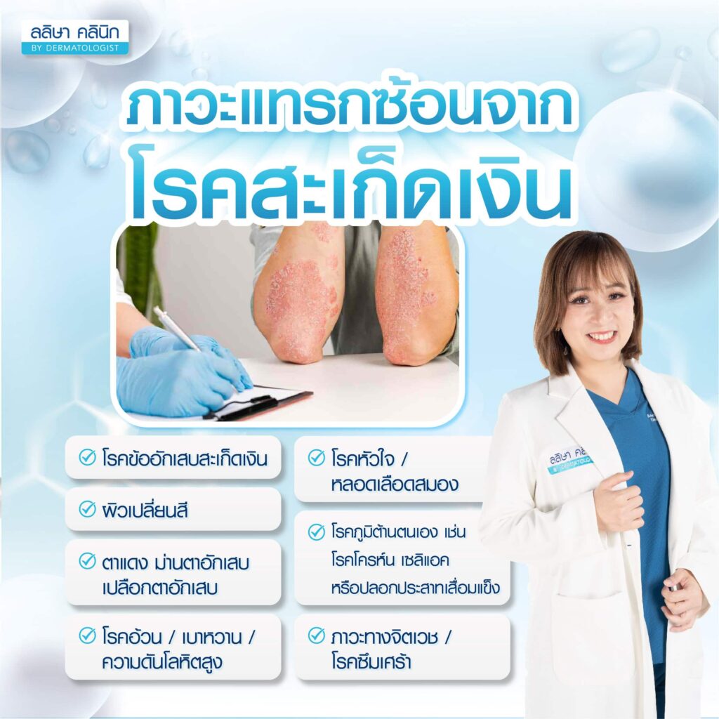 ภาวะแทรกซ้อนของโรคสะเก็ดเงิน