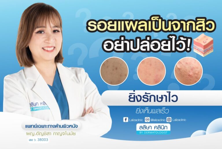 รอยแผลเป็นจากสิว อย่าปล่อยไว้! ยิ่งรักษาไว ยิ่งเห็นผลเร็ว