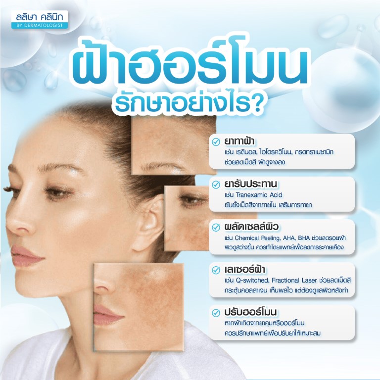 รักษาฝ้าฮอร์โมน