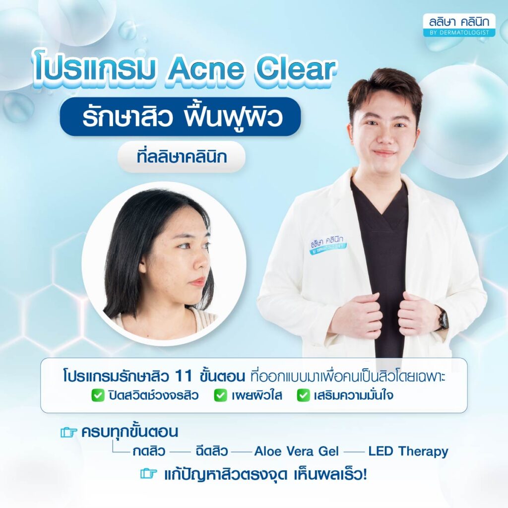 รีวิวคุณบิว Acne Clear