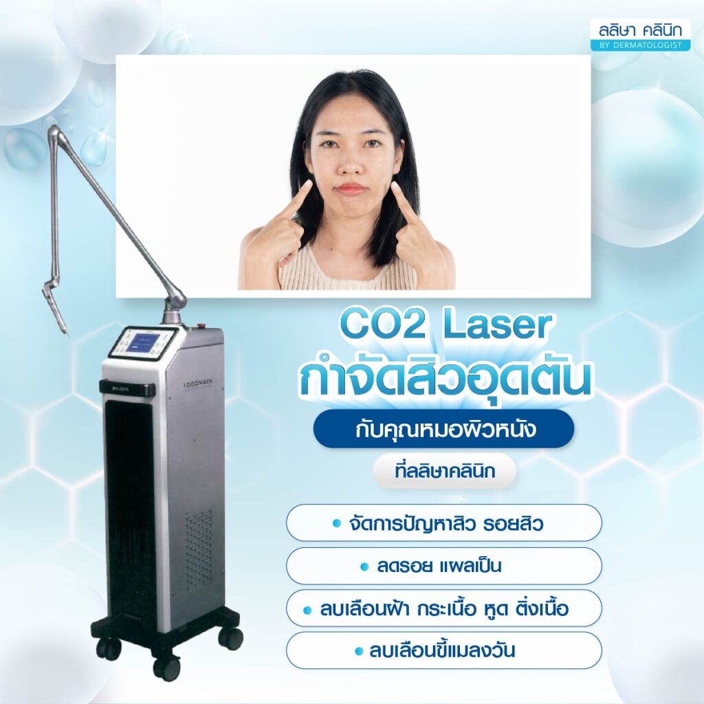 รีวิวคุณบิว co2 laser