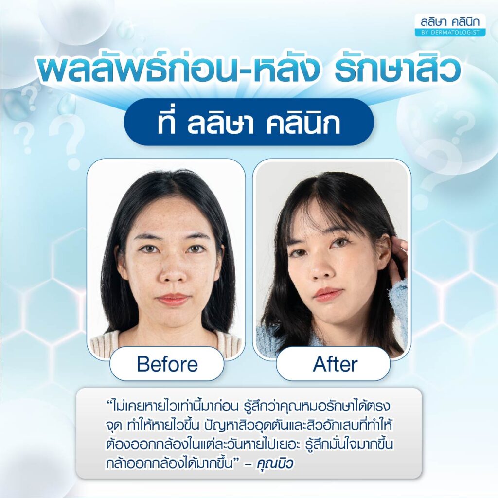 รีวิวคุณบิว ผลลัพธ์หลังรักษา