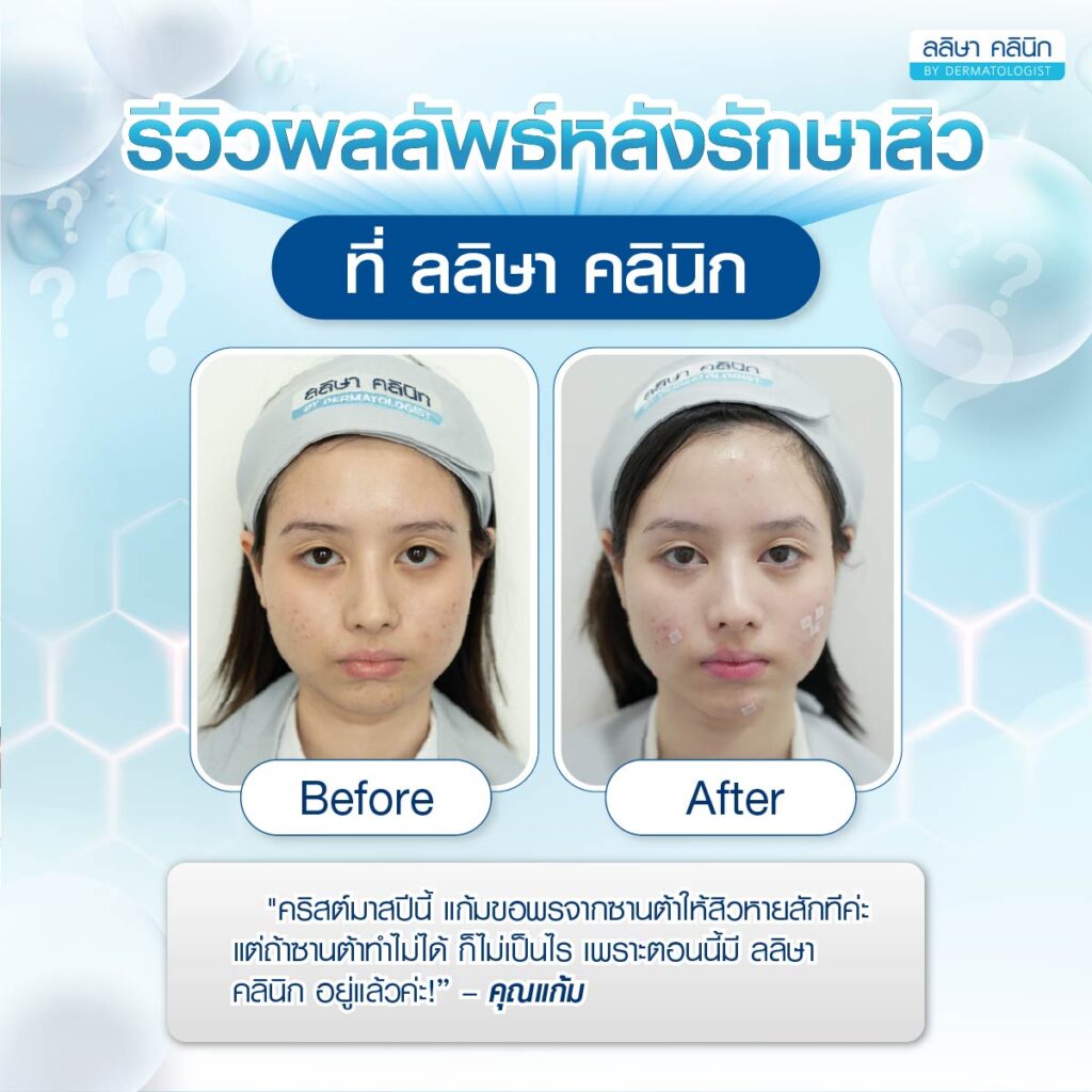 รีวิวคุณแก้ม หลังรักษาสิว