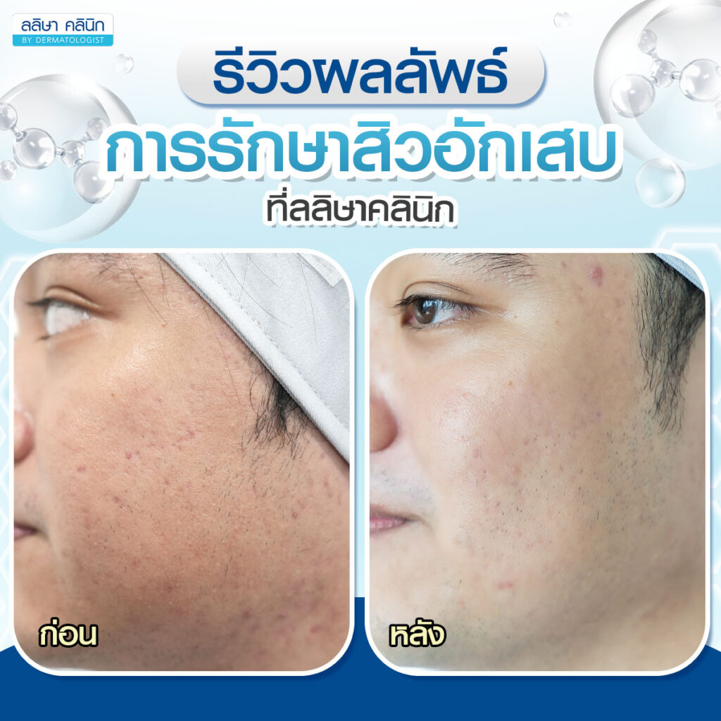 รีวิวผลลัพธ์การรักษาสิวอักเสบ ที่ลลิษาคลินิก_