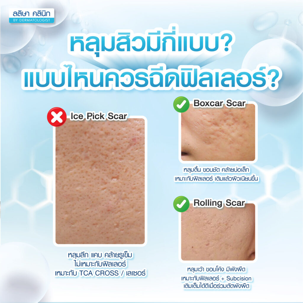 ลักษณะหลุมสิวIce Pick Scar Boxcar Scar Rolling ScarลักษณะหลุมสิวIce Pick Scar Boxcar Scar Rolling Scar