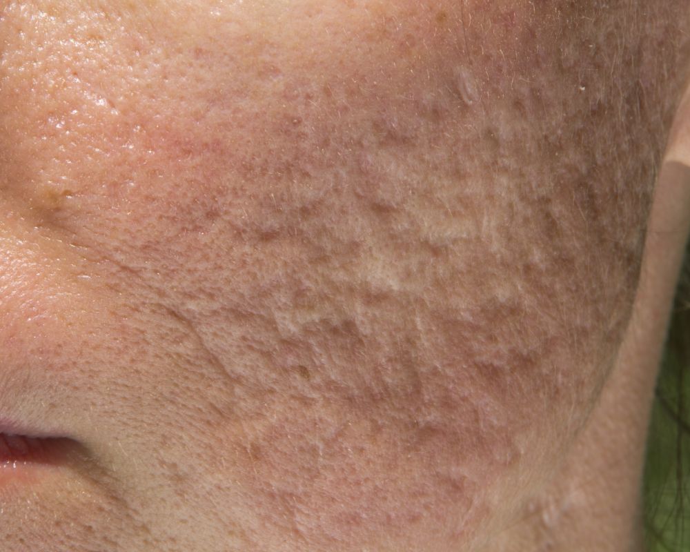 ลักษณะหลุมสิวที่ทำฟิลเลอร์หลุมสิว