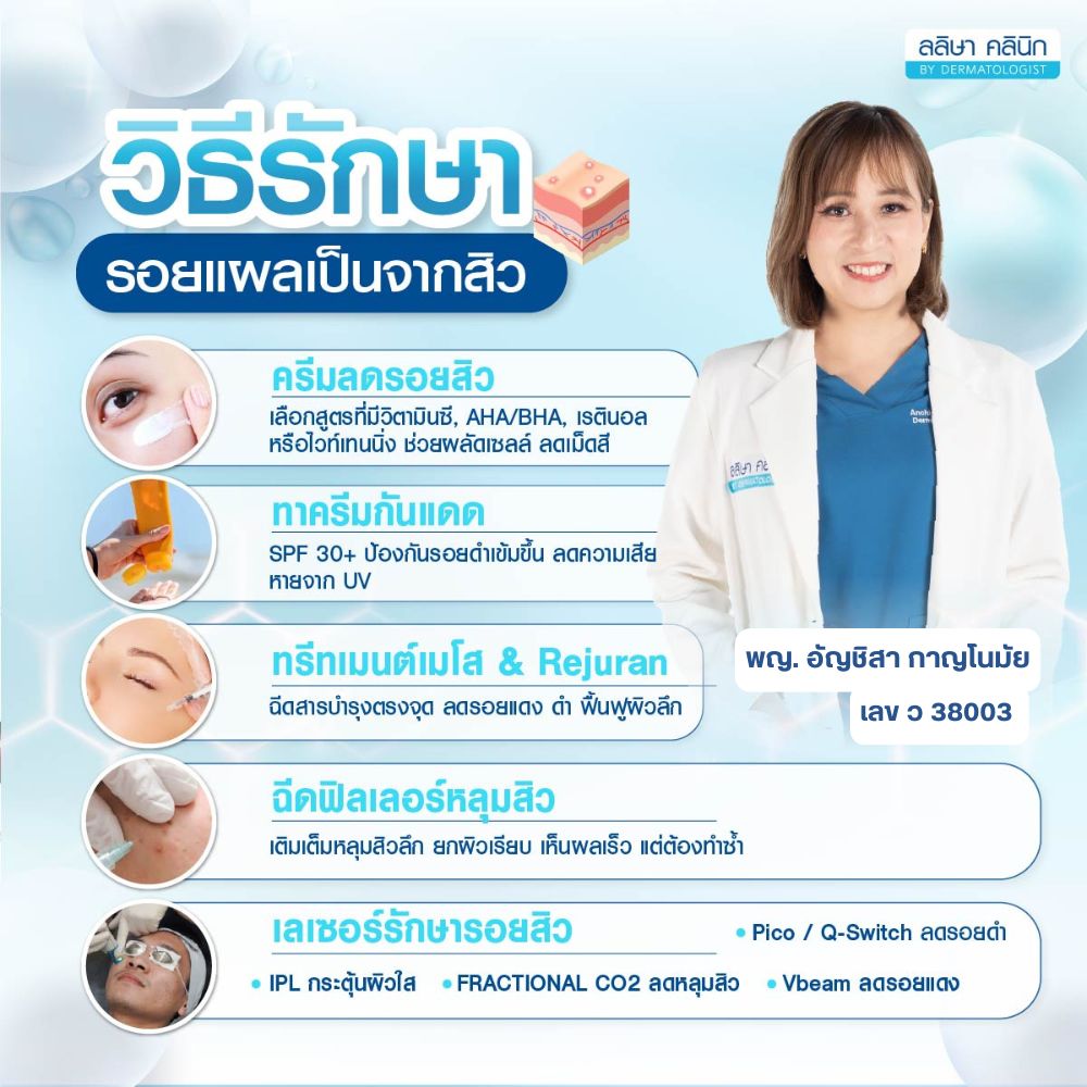 วิธีรักษารอยแผลเป็นจากสิว