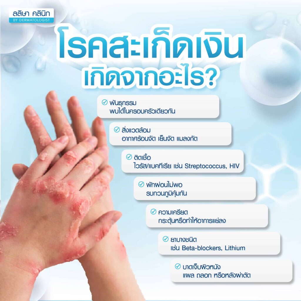สาเหตุโรคสะเก็ดเงิน