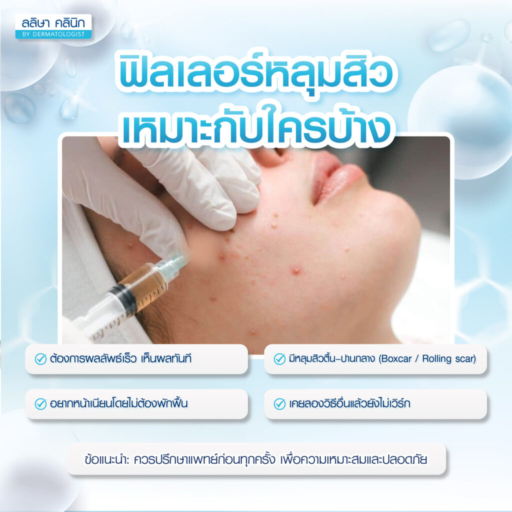 หลุมสิวแบบตื้นถึงปานกลาง ทำฟิลเลอร์หลุมสิว