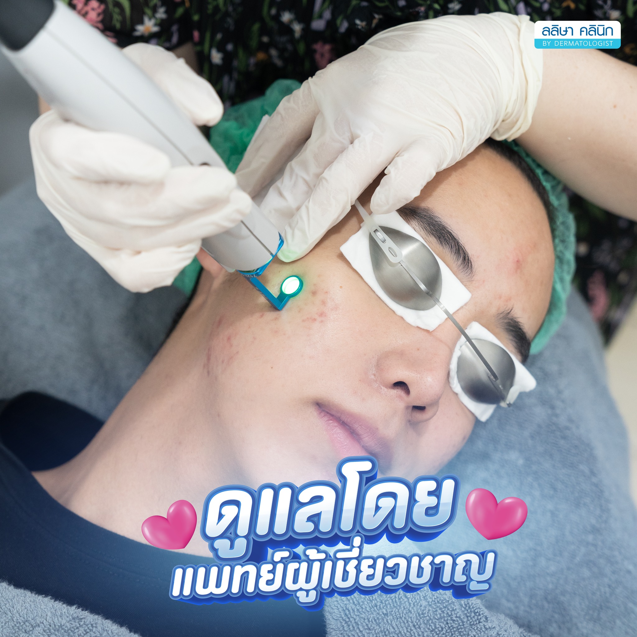 เลเซอร์รักษาสิว โดยเทคโนโลยี vbeam laser