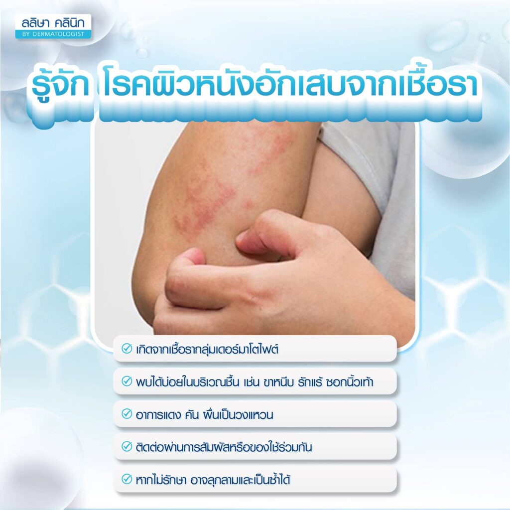 โรคผิวหนังอักเสบจากเชื้อรา คือ
