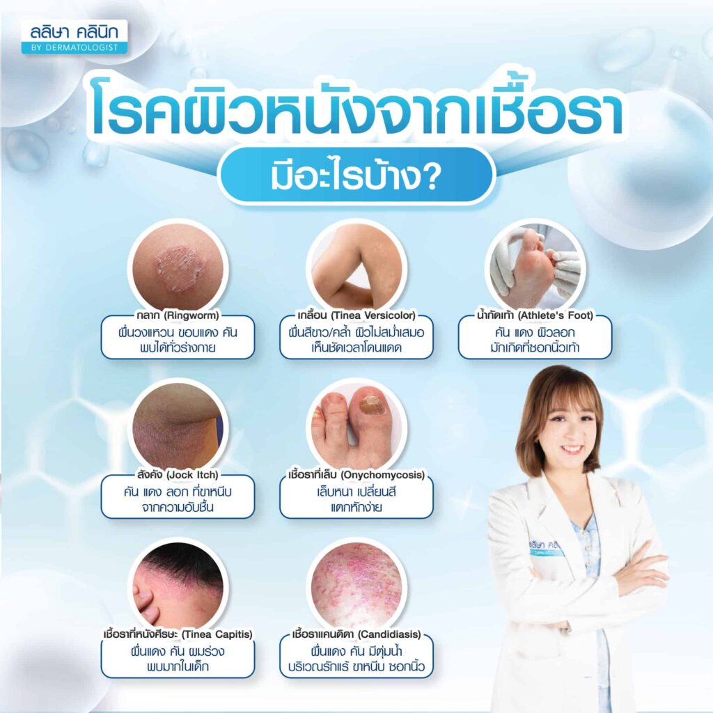 โรคผิวหนังอักเสบจากเชื้อรา มีอะไรบ้าง