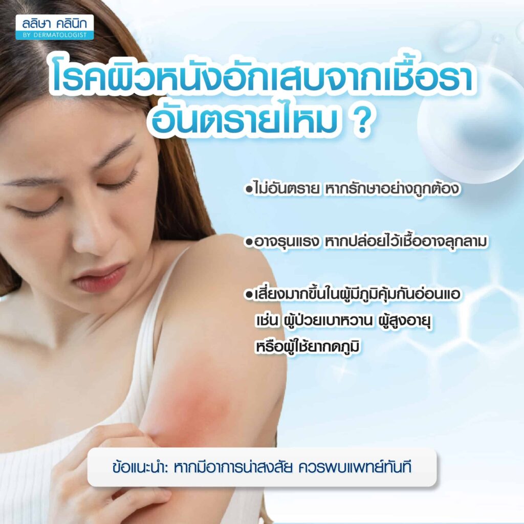 โรคผิวหนังอักเสบจากเชื้อรา อันตรายไหม