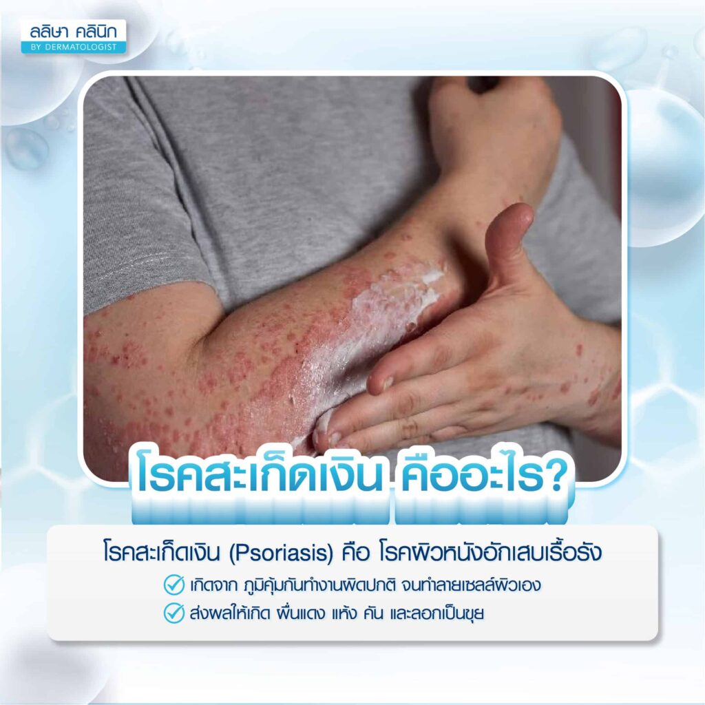 โรคสะเก็ดเงิน คือ