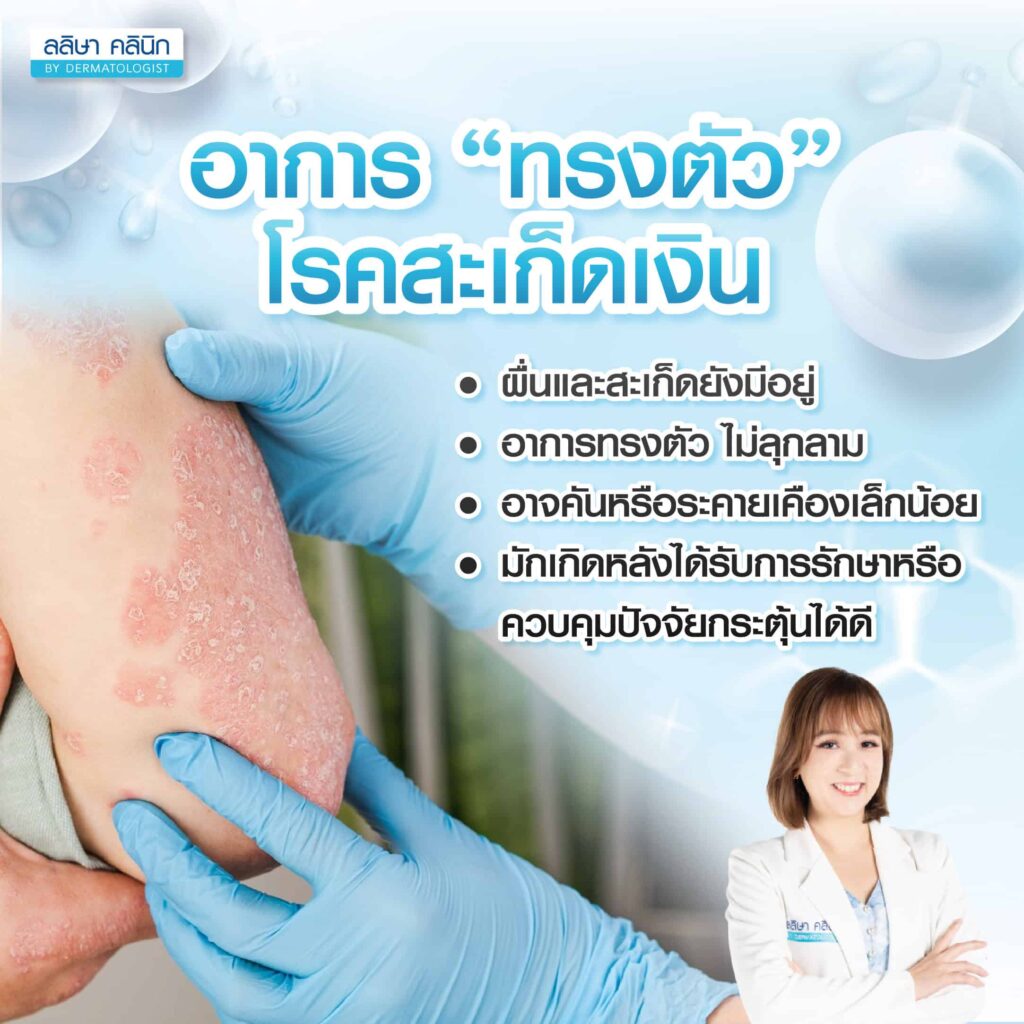 โรคสะเก็ดเงิน ระยะทรงตัว