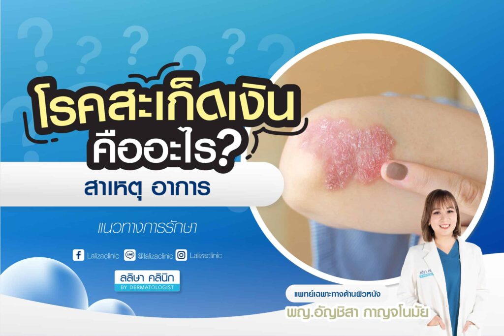 โรคสะเก็ดเงิน สาเหตุ อาการ การรักษา