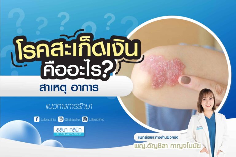โรคสะเก็ดเงิน สาเหตุ อาการ การรักษา