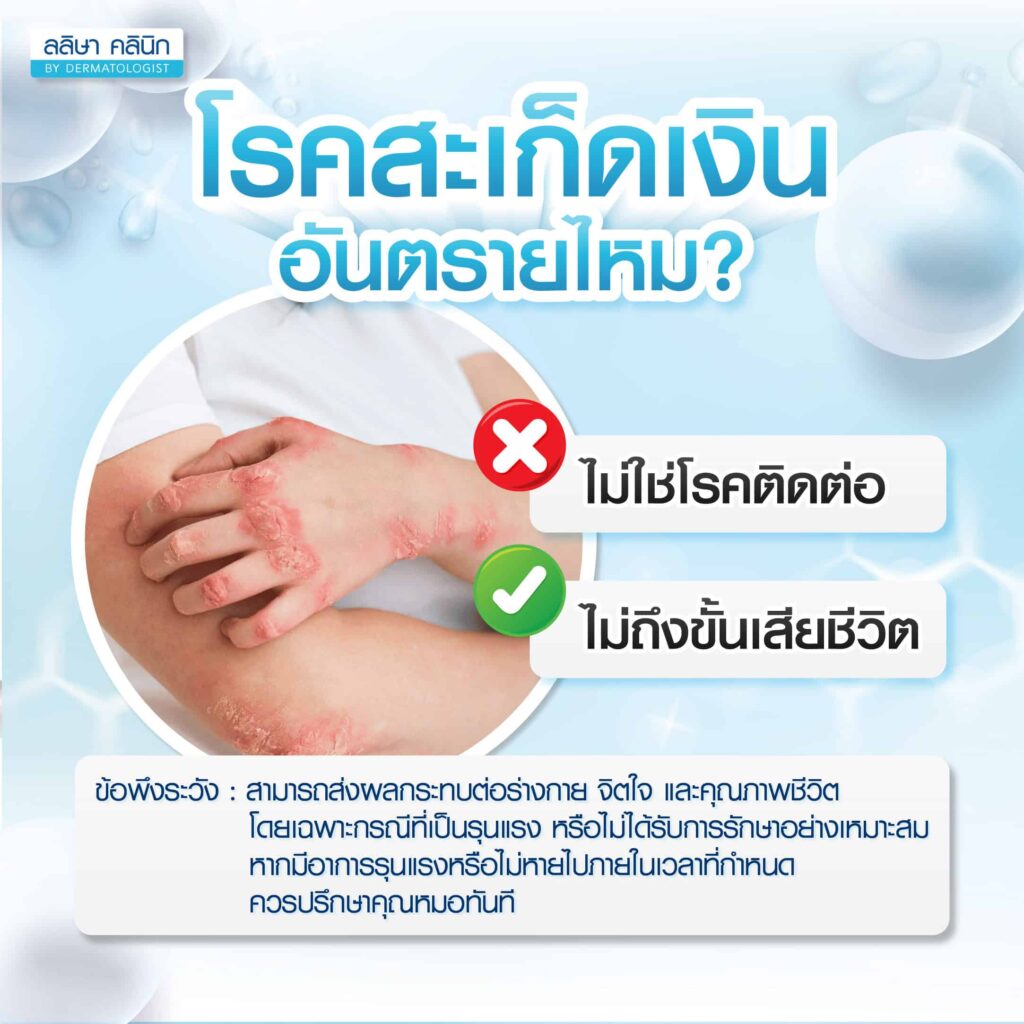 โรคสะเก็ดเงิน อันตรายไหม