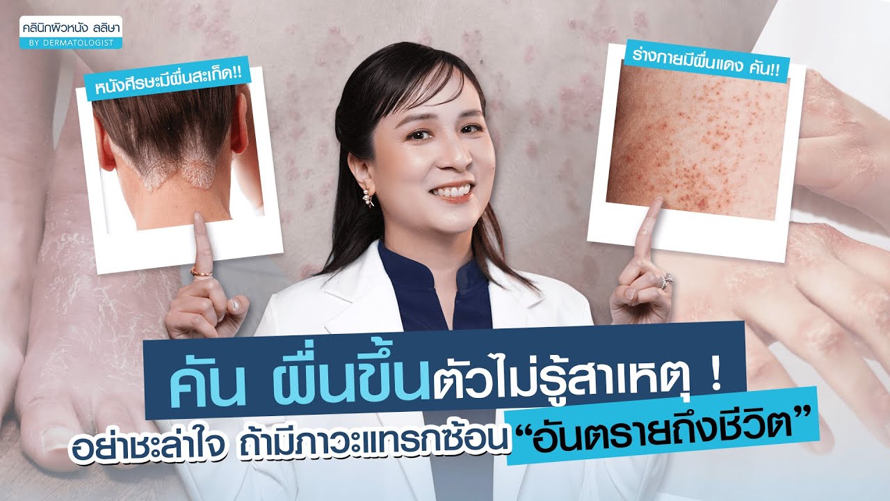 โรคสะเก็ดเงิน อาการ วิธีรักษา
