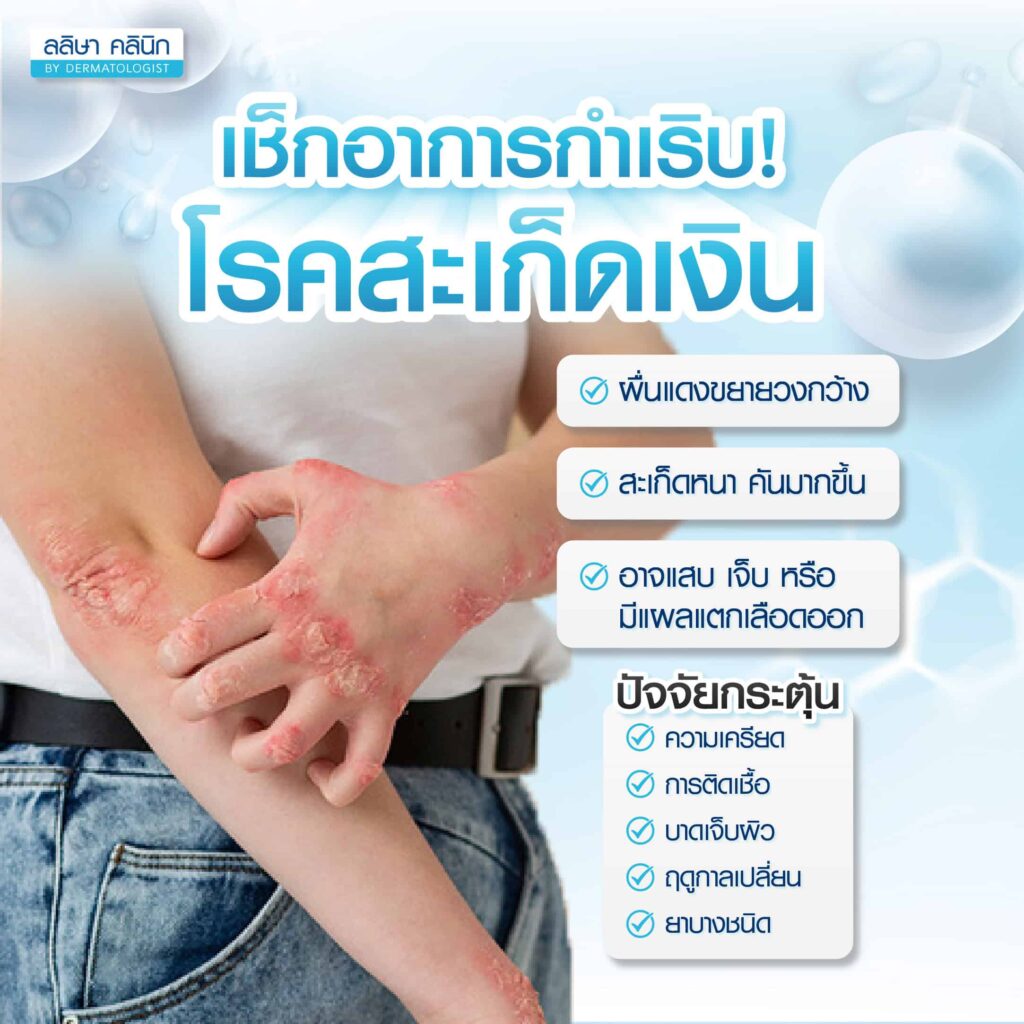 โรคสะเก็ดเงิน อาการระยะกำเริบ