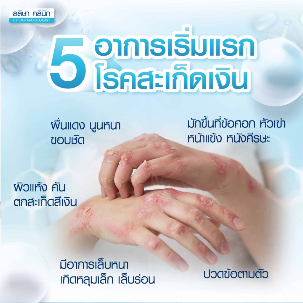 โรคสะเก็ดเงิน อาการเริ่มแรก