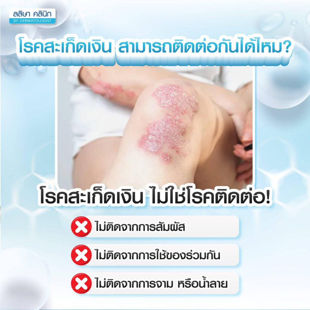 โรคสะเก็ดเงินติดต่อกันได้ไหม