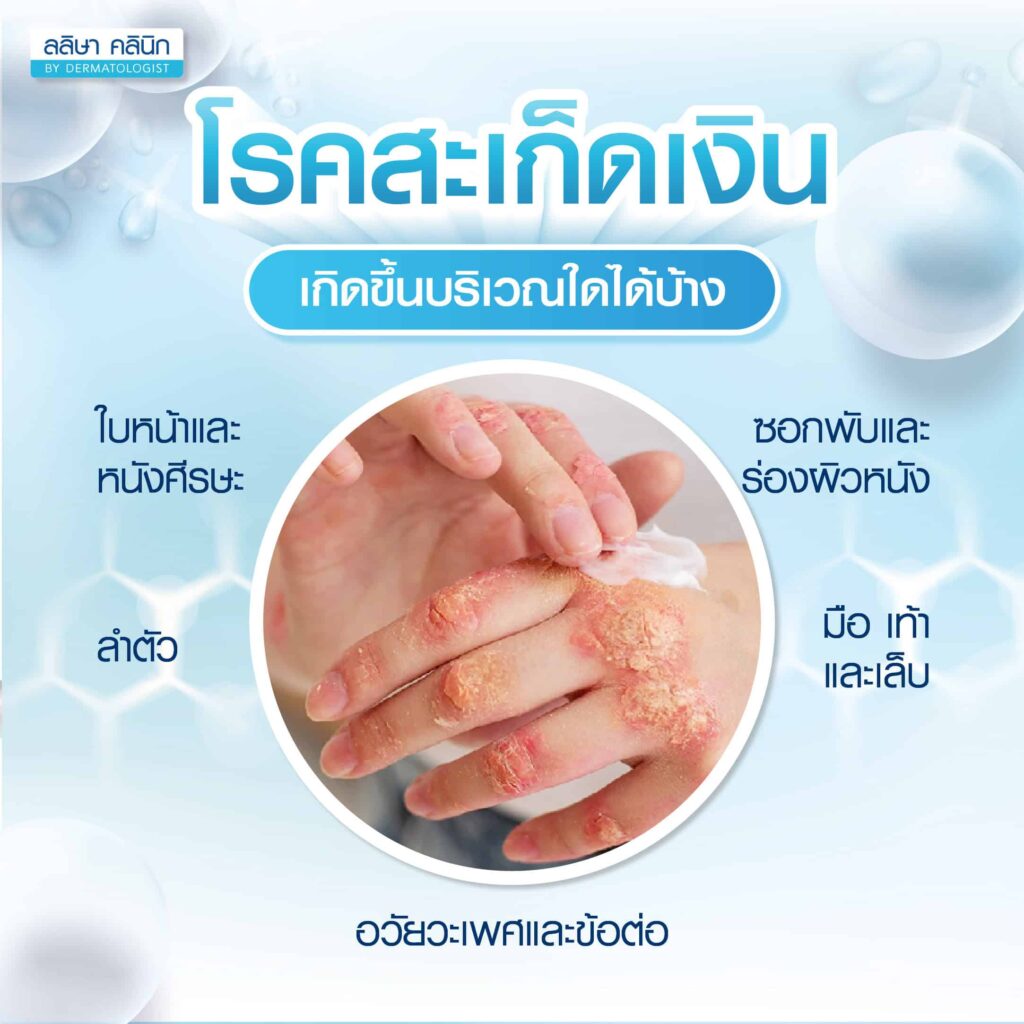 โรคสะเก็ดเงินมักจะขึ้นบริเวณไหน