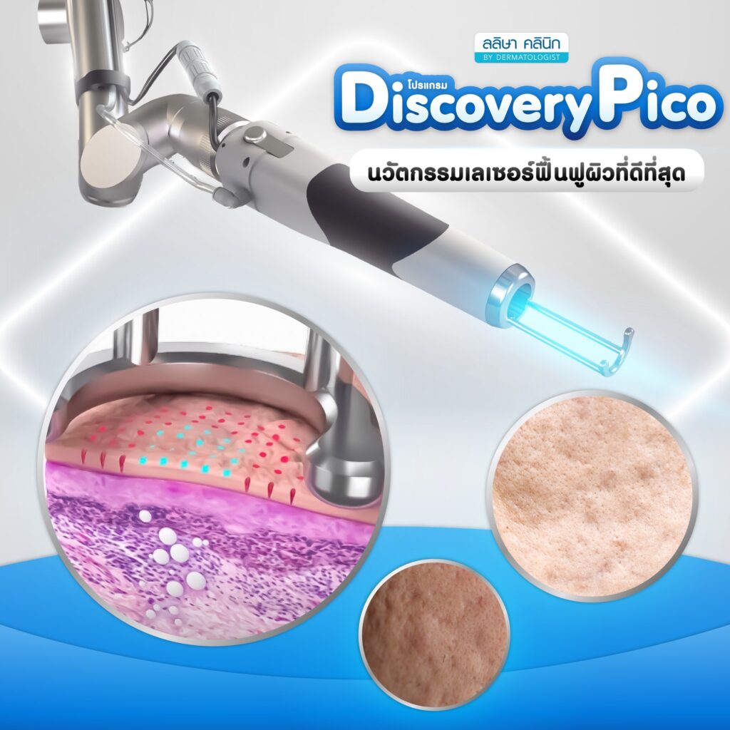 Pico Laser เลเซอร์รักษาหลุมสิว