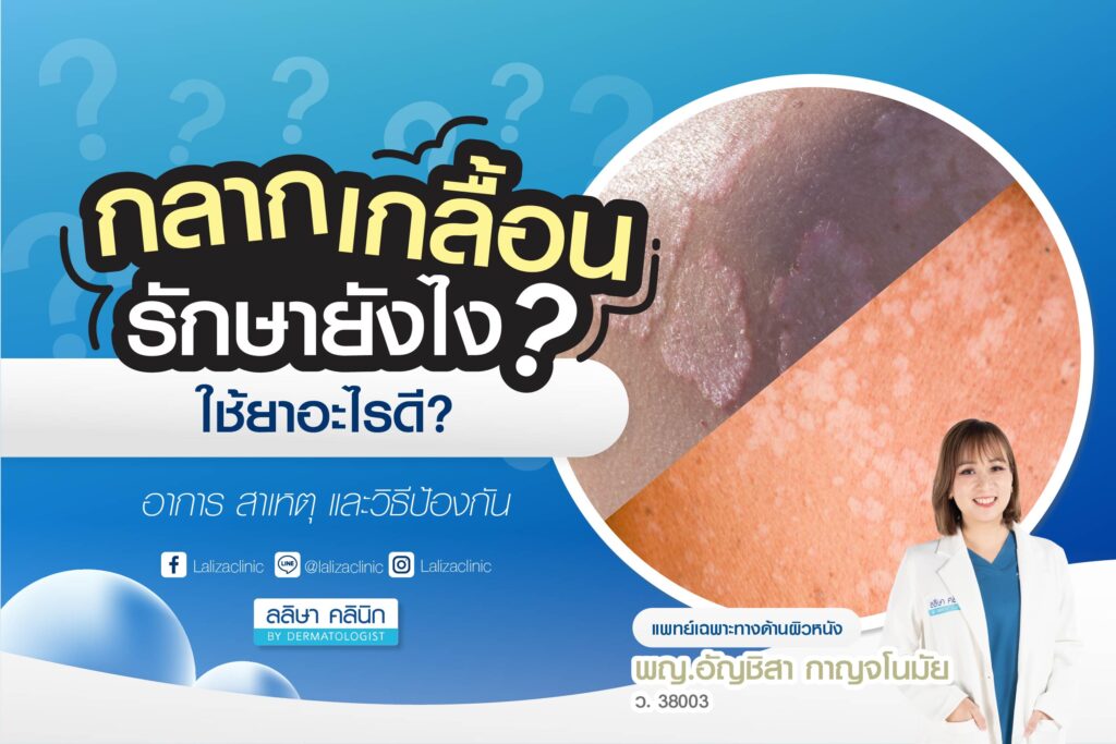 กลาก เกลื้อน รักษายังไง ใช้ยาอะไรดี อาการ สาเหตุ และวิธีป้องกัน