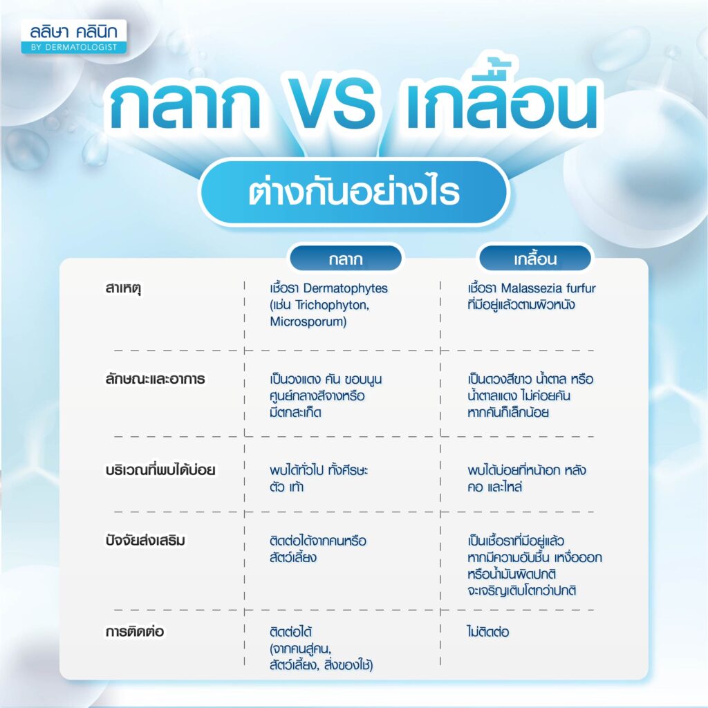 กลาก เกลื้อนต่างกันอย่างไร