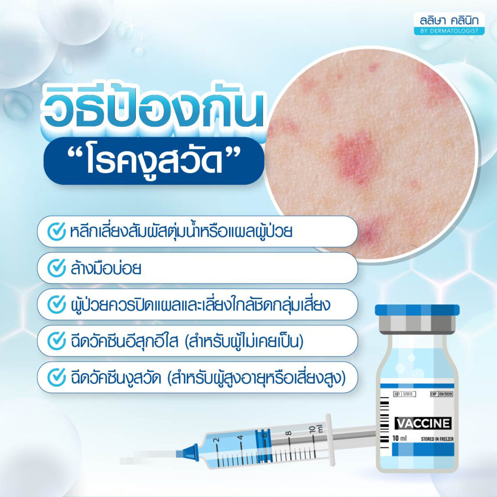 การป้องกันโรคงูสวัด