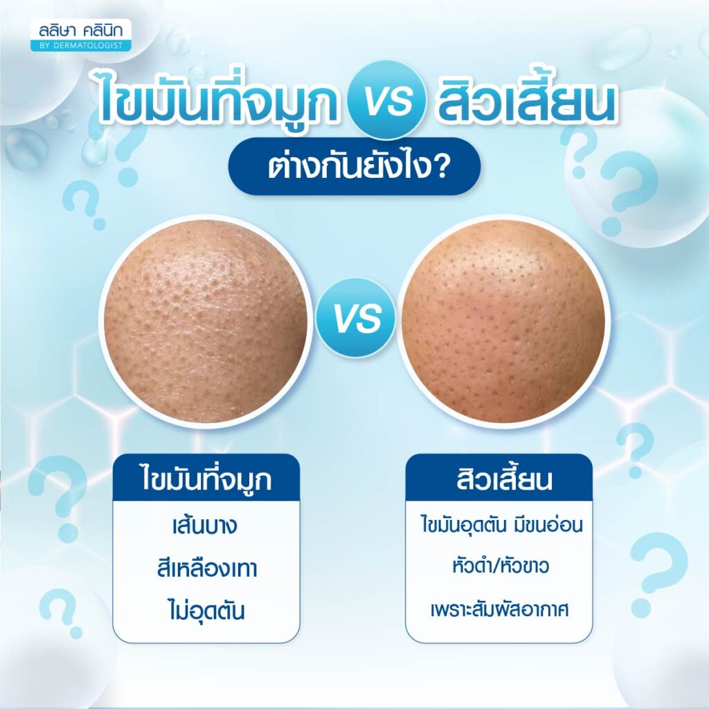 ความแตกต่างไขมันที่จมูกกับสิวเสี้ยน