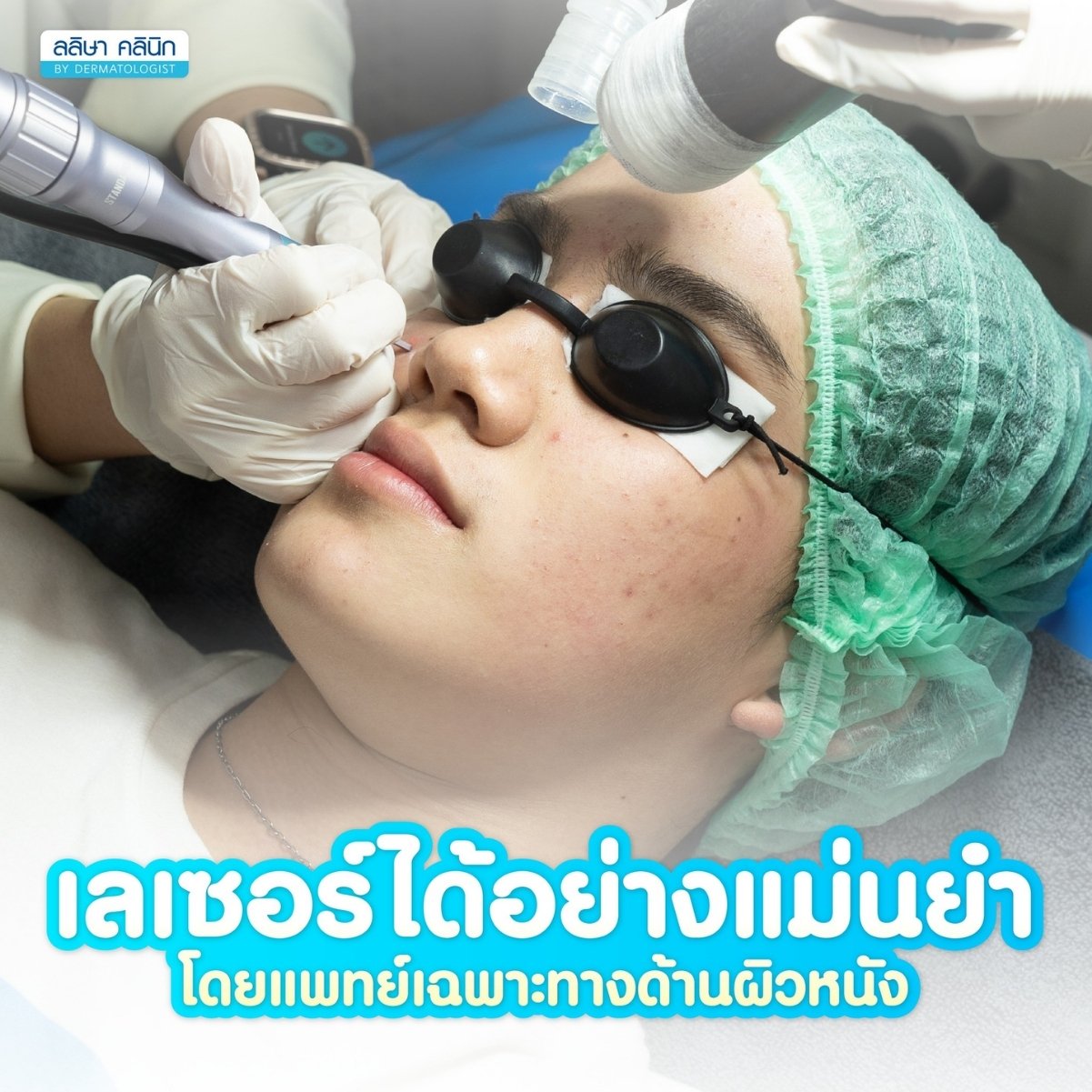 คุณหมอทำเลเซอร์ Co2 รักษาสิวให้คนไข้ที่เป็นสิวมานาน