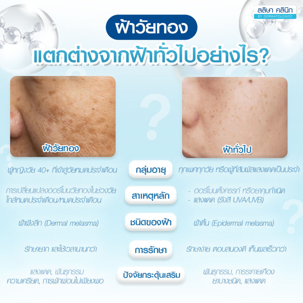 ฝ้าวัยทอง แตกต่างจากฝ้าทั่วไปอย่างไร