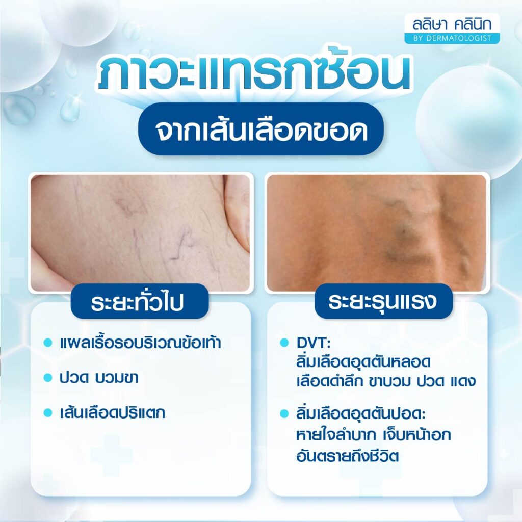 ภาวะแทรกซ้อนที่ควรรู้