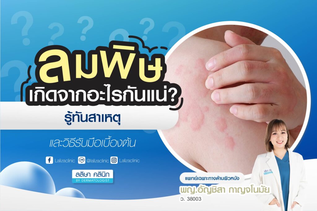 ลมพิษ สาเหตุ วิธีรับมือเบื้องต้น