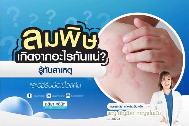 ลมพิษ สาเหตุ วิธีรับมือเบื้องต้น