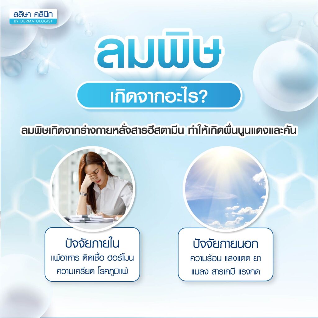 ลมพิษเกิดจากอะไร