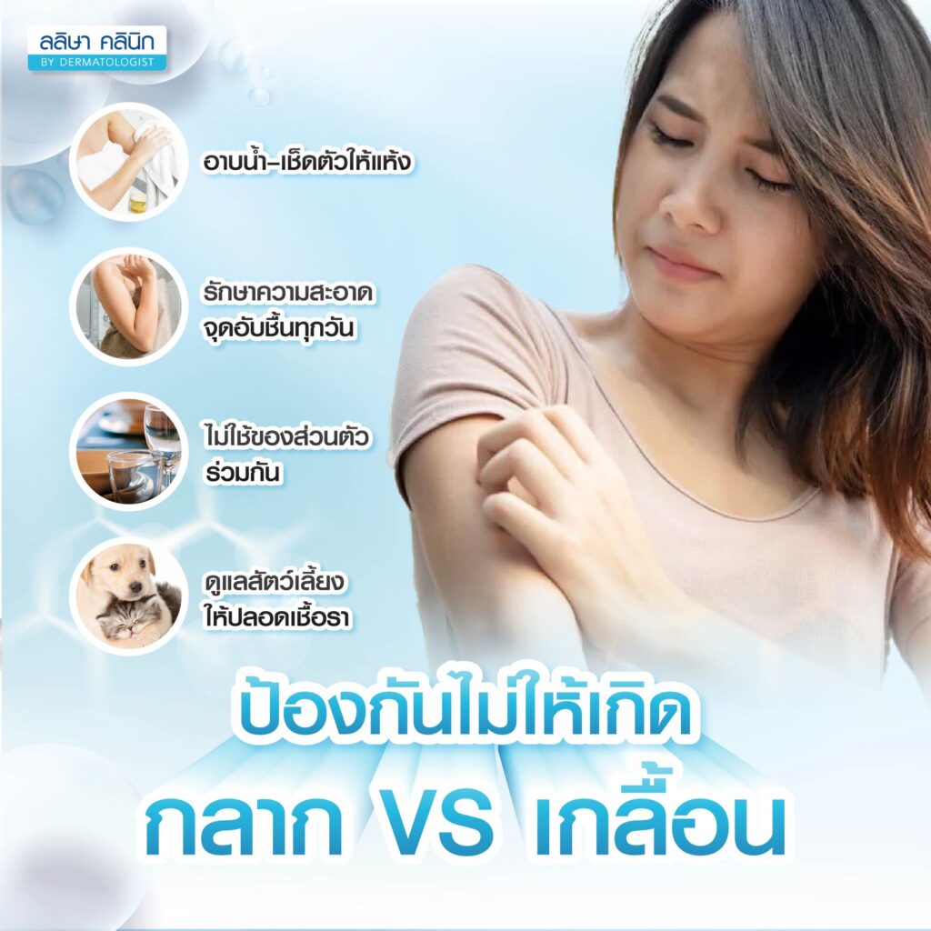 วิธีการป้องกันกลาก เกลื้อน