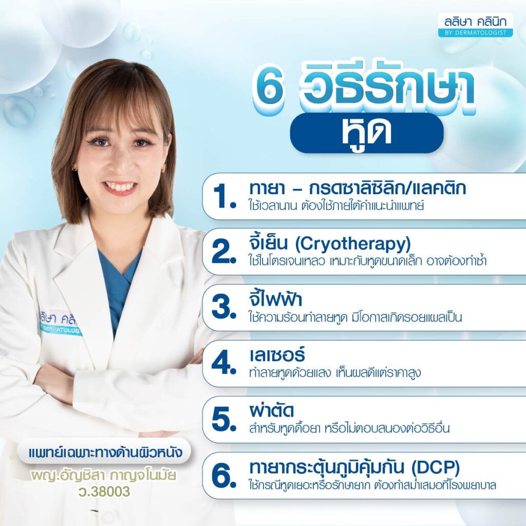 วิธีรักษาหูด