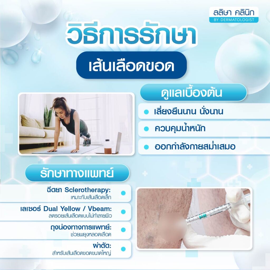 วิธีรักษาเส้นเลือดขอด