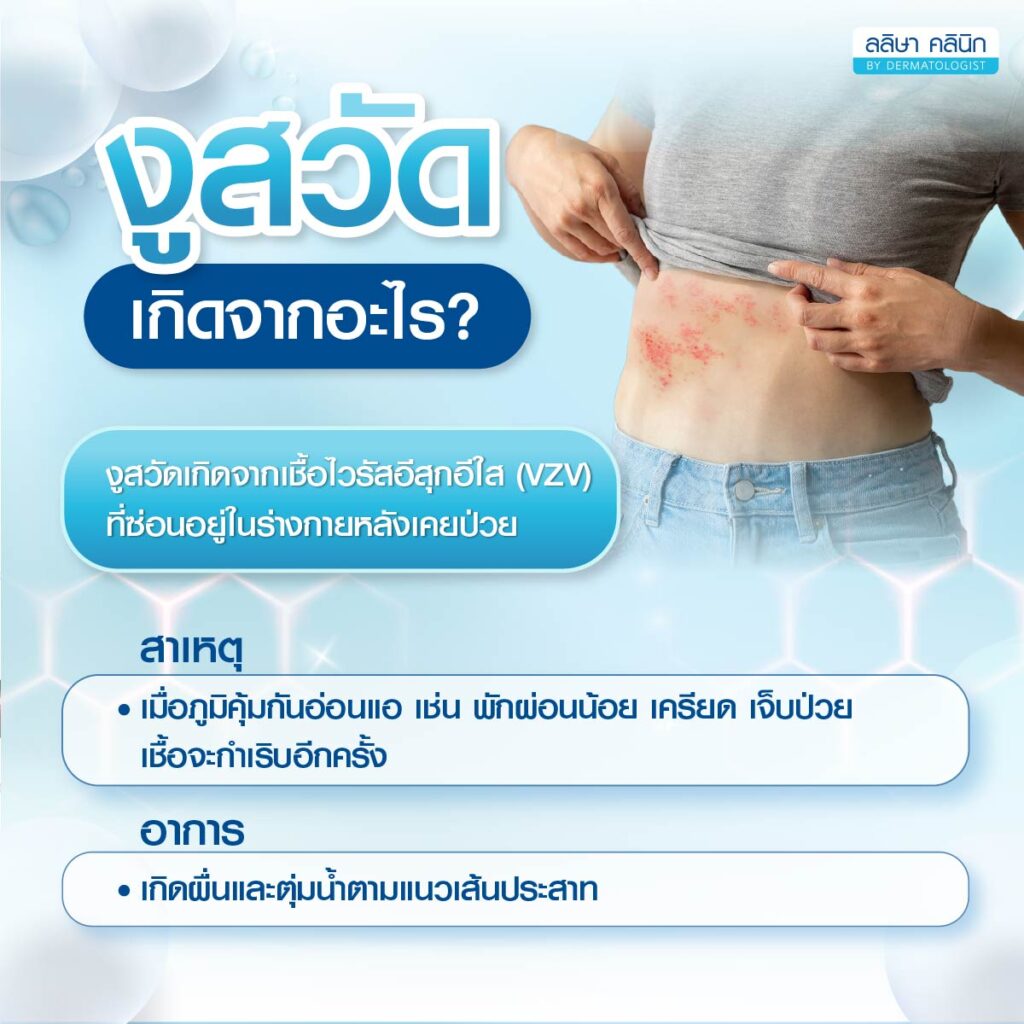 สาเหตุการเกิดโรคงูสวัด
