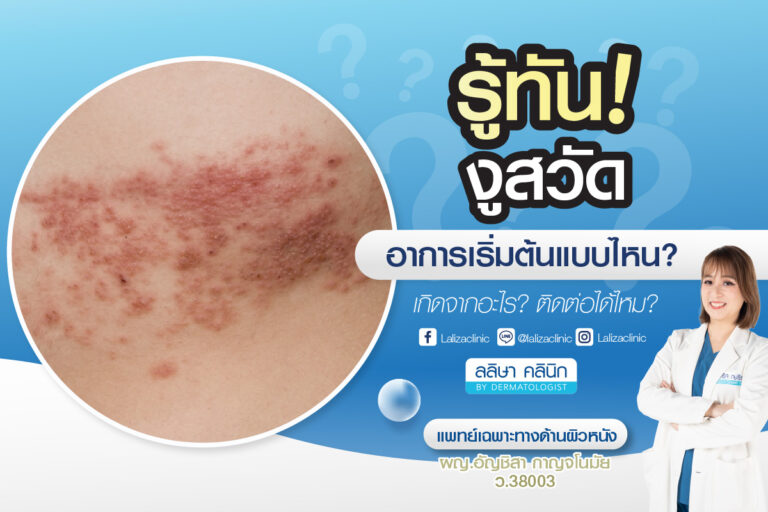 สาเหตุโรคงูสวัด อาการ การรักษา วิธีป้องกัน