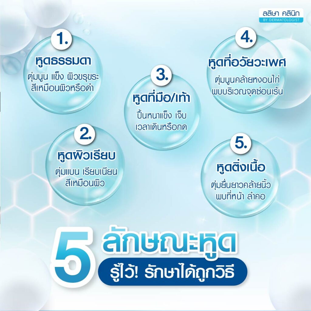 ลักษณะหูด
