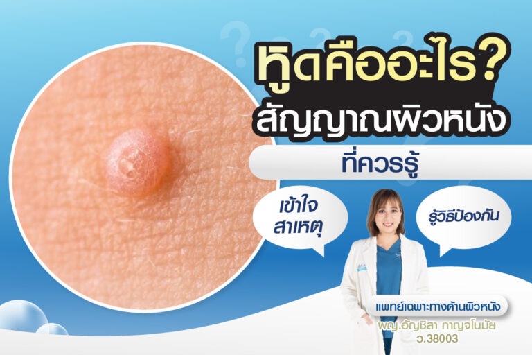 หูดเกิดจากอะไร? รักษาอย่างไรไม่ให้ลุกลาม