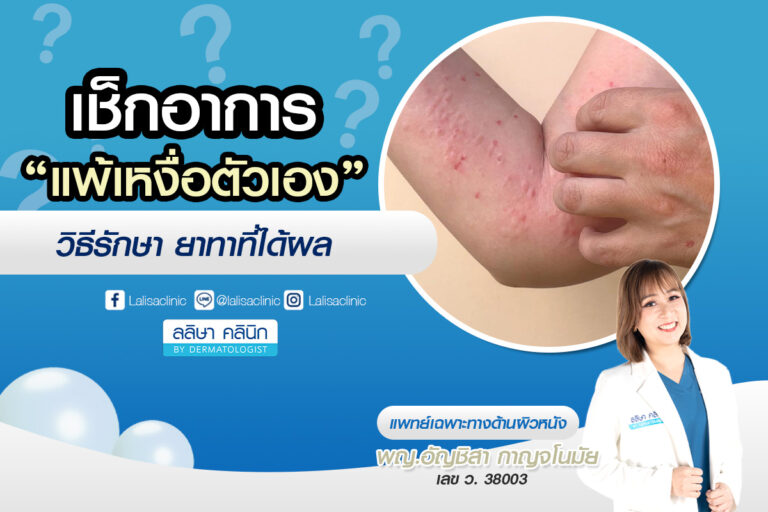 อาการ แพ้เหงื่อตัวเอง วิธีรักษา ยาทาที่ได้ผล
