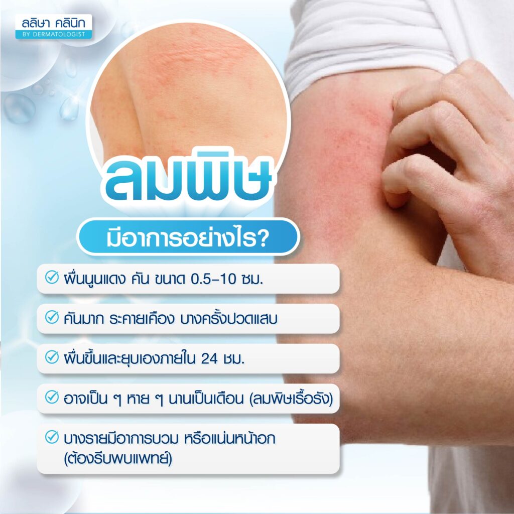 อาการลมพิษ