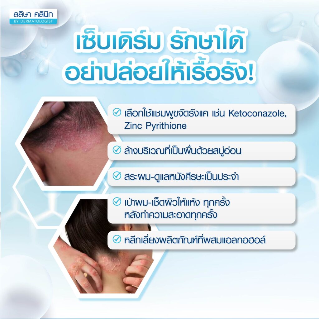 เซ็บเดิร์ม วิธีรักษา