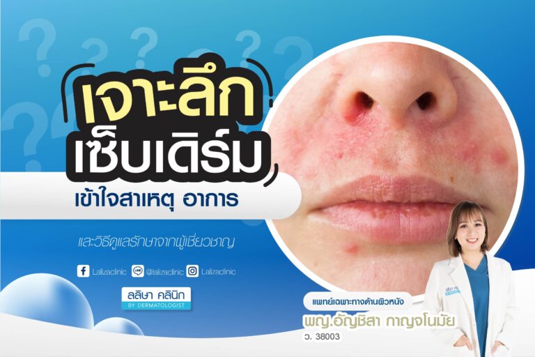 เซ็บเดิร์ม สาเหตุ อาการ และวิธีดูแลรักษา